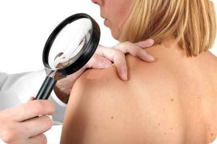 Pensez à faire contrôler régulièrement vos grains de beauté par un dermatologue